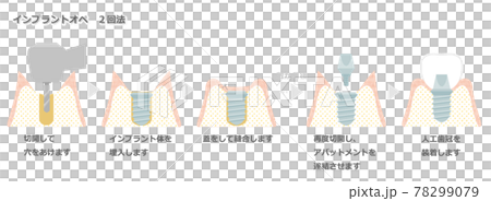 インプラントオペ_2回法 インプラントオペ_2回法 78299079