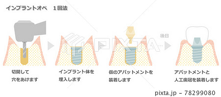 インプラントオペ_1回法 78299080