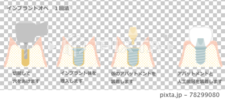 インプラントオペ_1回法 78299080