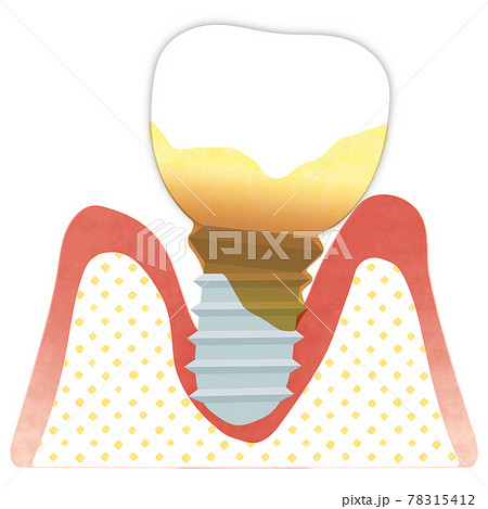 インプラント歯周炎(重度) インプラント歯周炎(重度) 78315412