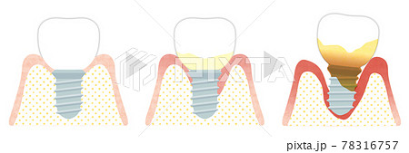 インプラント歯周炎になる流れ インプラント歯周炎になる流れ 78316757