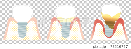 インプラント歯周炎になる流れ インプラント歯周炎になる流れ 78316757