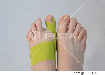 Feet close-up, top view. There is a tap on the big toe. Correction of finger deformity. Hallux valgus. Innovative medicine 78335936