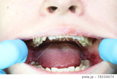 Operation removal of wisdom teeth - eights. Stitching, postoperative period 78339074