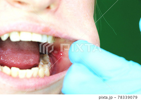 Painful ulcer and stomatitis on the mucous cheek of a girl. After the operation to remove the wisdom teeth. Stitches and postoperative period 78339079
