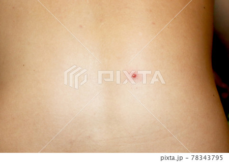 Close up of a pimple on the back 78343795