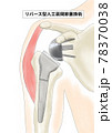 リバース型人工肩関節全置換術 78370038