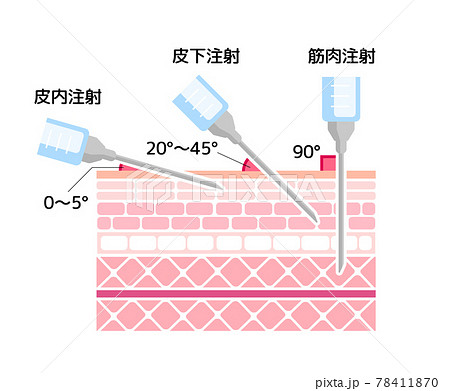 注射の刺入角度の違い ベクターイラスト 筋肉注射 皮下注射 新型コロナワクチンのイラスト素材