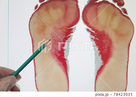 The doctor points out the signs of flat feet. The doctor's hand in a glove points to the footprint with a pointer. Plantography 78423035