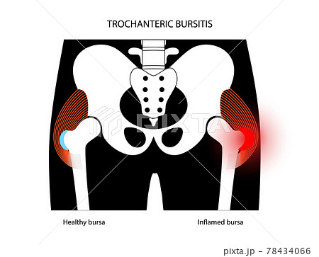 Bursitis inflammation concept Bursitis inflammation concept 78434066