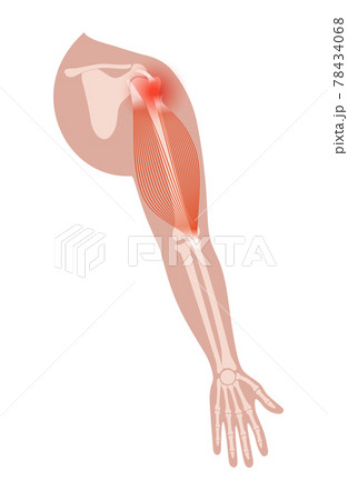 Biceps tear trauma Biceps tear trauma 78434068