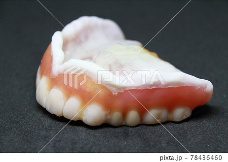 治療が終わるまでの仮の入歯、合わなくなったので裏打をして補修してある 治療が終わるまでの仮の入歯、合わなくなったので裏打をして補修してある 78436460