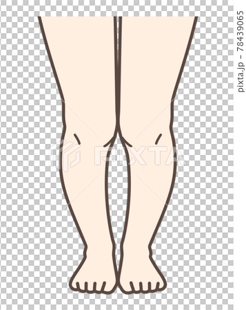 XO腿膝疾病說明圖 78439065