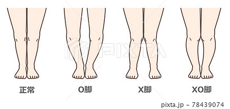 変形性膝関節症　図解 78439074