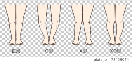 膝關節骨關節炎圖示 78439074