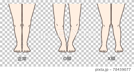 膝關節骨關節炎圖示 膝關節骨關節炎圖示 78439077