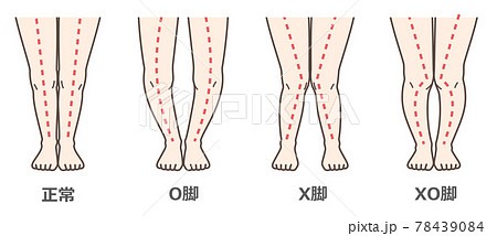 変形性膝関節症　図解 78439084