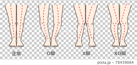 膝關節骨關節炎圖示 78439084