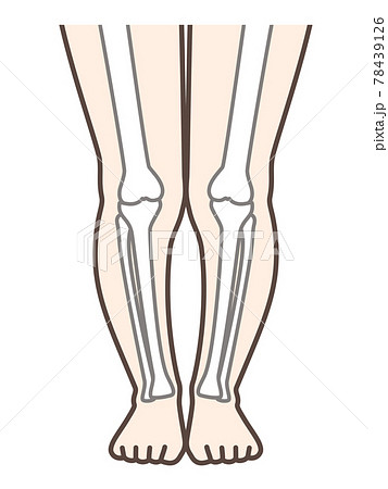 Xo脚 膝の病気の解説用イラストのイラスト素材