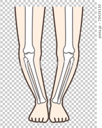 O-legged legs, illustrations for explaining diseases of the legs and knees 78439130