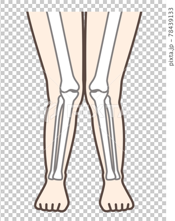 X脚 膝の病気の解説用イラストのイラスト素材