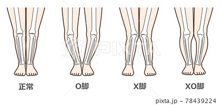 変形性膝関節症　図解 78439224