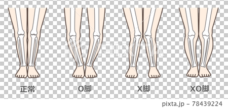 変形性膝関節症　図解 78439224