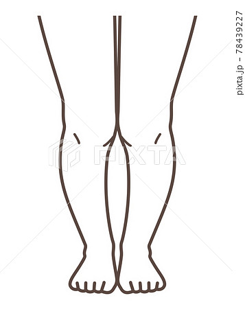 XO脚、膝の病気の解説用イラスト 78439227