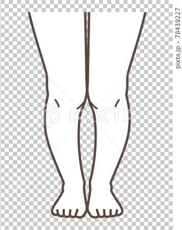 XO脚、膝の病気の解説用イラスト 78439227