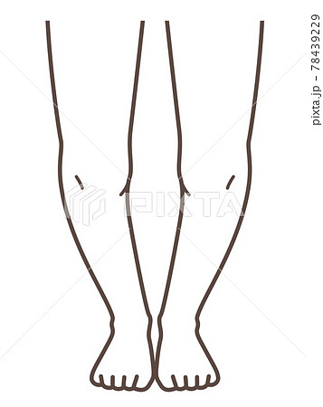 O脚な足 脚、膝の病気の解説用イラスト O脚な足 脚、膝の病気の解説用イラスト 78439229