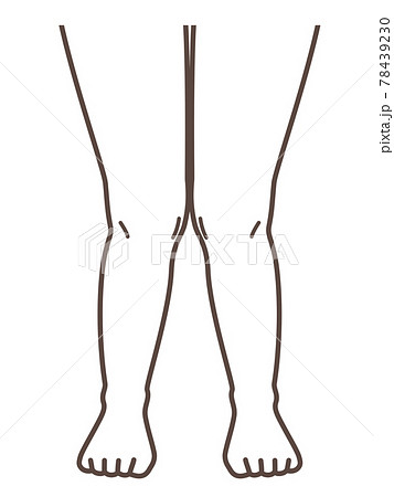 X脚 膝の病気の解説用イラストのイラスト素材