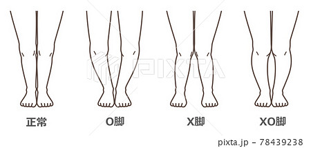 変形性膝関節症　図解 78439238