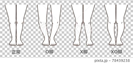 変形性膝関節症　図解 78439238