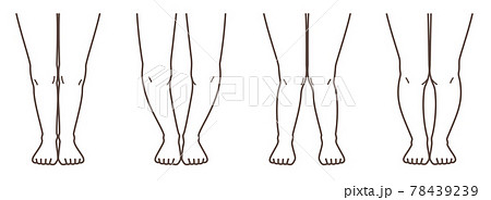 変形性膝関節症　図解 78439239