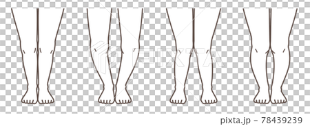 Knee osteoarthritis illustrated 78439239