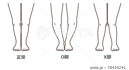 変形性膝関節症 図解 変形性膝関節症 図解 78439241