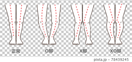 膝關節骨關節炎圖示 78439245