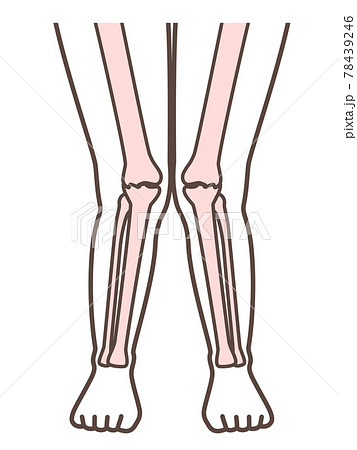 X脚 膝の病気の解説用イラストのイラスト素材