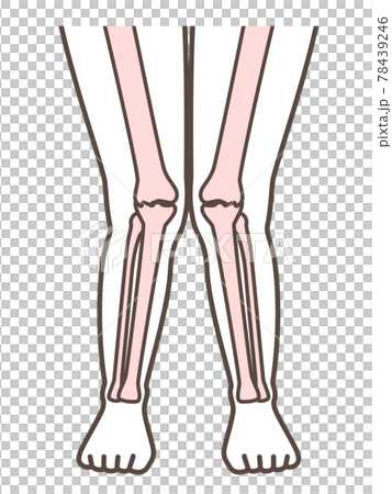 解釋 X 腿和膝蓋疾病的插圖 78439246