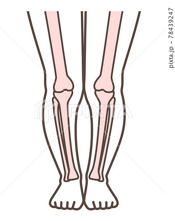 Xo脚 膝の病気の解説用イラストのイラスト素材