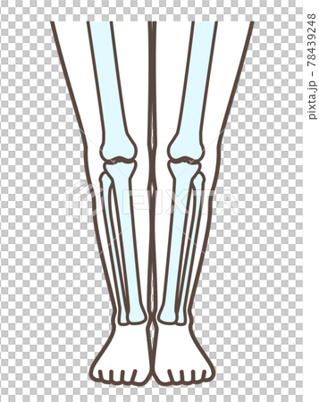 解釋正常腳和膝蓋疾病的插圖 解釋正常腳和膝蓋疾病的插圖 78439248