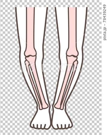 O-legged legs, illustrations for explaining diseases of the legs and knees O-legged legs, illustrations for explaining diseases of the legs and knees 78439249