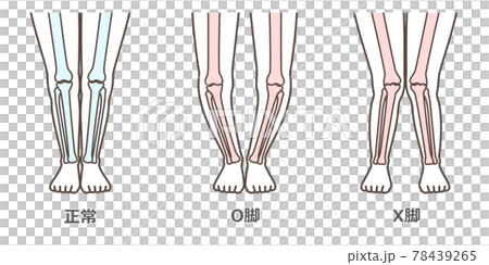 膝關節骨關節炎圖示 78439265