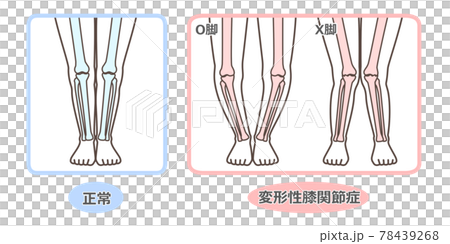 膝關節骨關節炎圖示 78439268