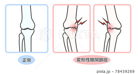 変形性膝関節症　図解 78439269