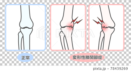 膝關節骨關節炎圖示 78439269