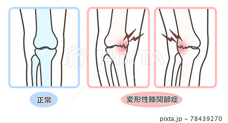 変形性膝関節症　図解 78439270