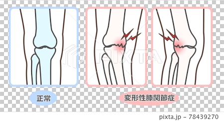 変形性膝関節症　図解 78439270