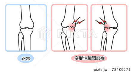 変形性膝関節症 図解のイラスト素材