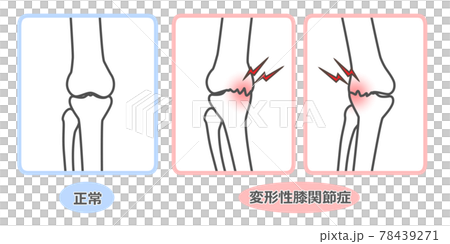 変形性膝関節症　図解 78439271
